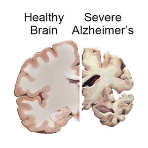 Alzheimer's Disease: The Basics - Alzheimer's San Diego