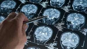 the-latest-in-alzheimers-research-free-class