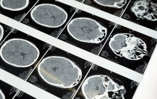 Brain scan for dementia