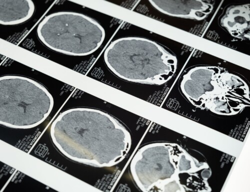 Types of Vascular Dementia & Vascular Cognitive Impairment (VCI)